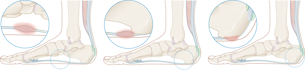Verschillende locaties van een peesplaatontsteking